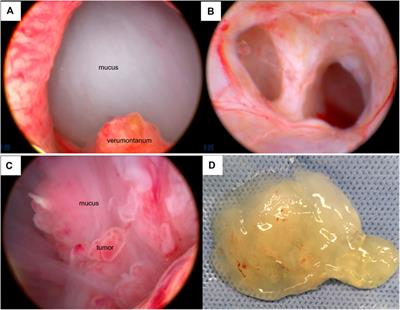 Case Report: Mucinous Adenocarcinoma Arising From Congenital Ejaculatory Duct Cyst